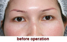 plastic-surgery-blepharoplasty